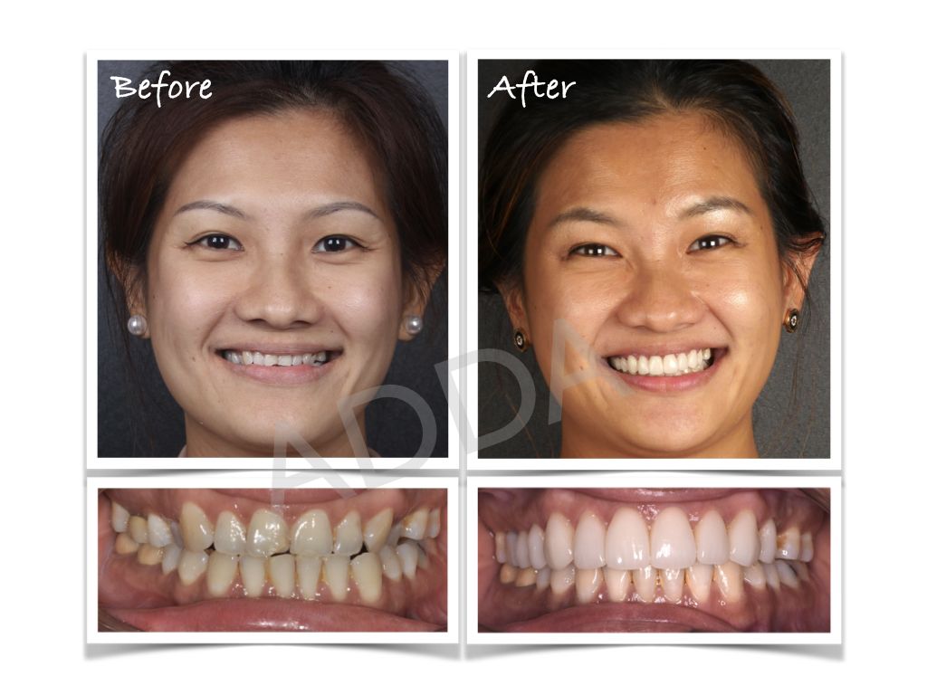 Smile Makeover: Combining Gum Sculpting with Cosmetic Dentistry
