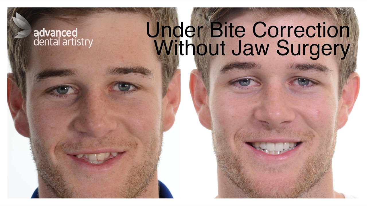 Dental Artistry Before and After: Inspiring Smile Transformations