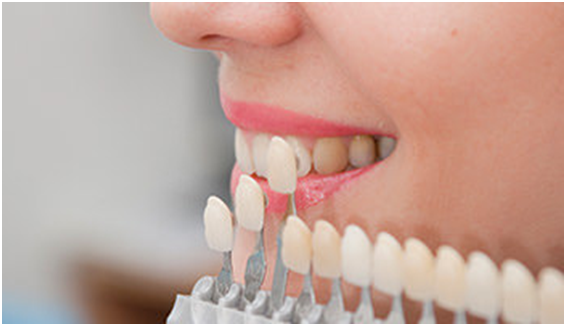 The Pros and Cons of Choosing Dental Veneers