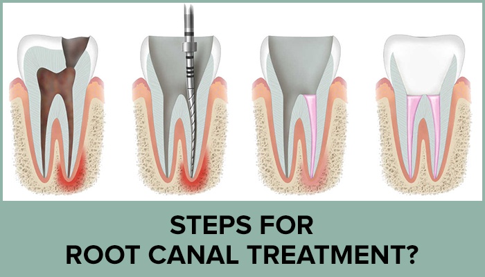 Understanding Root Canal Therapy: A Step-by-Step Guide