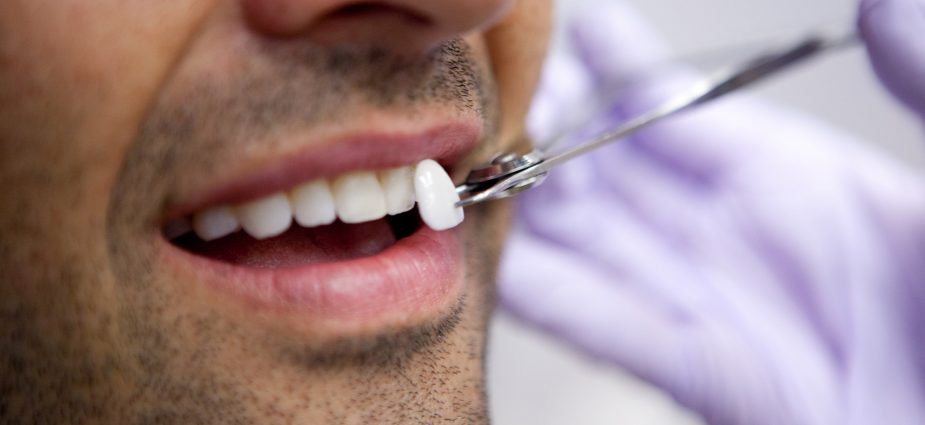 The Process of Getting Dental Veneers: What to Expect