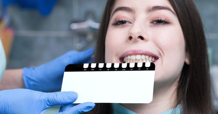 A Beginner’s Guide to Understanding Dental Veneers
