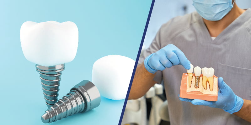 How Dental Implants Can Transform Your Smile and Function
