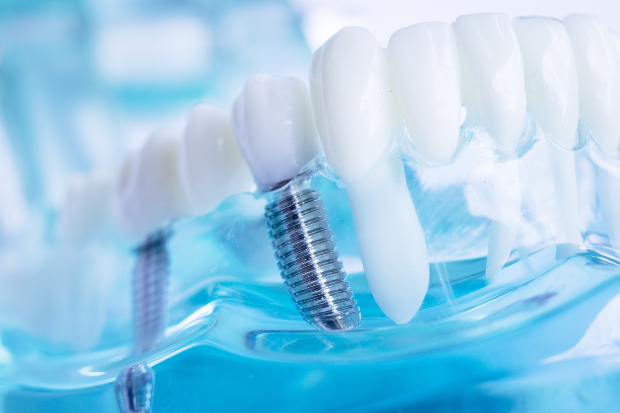Dental Implants: Aftercare and Recovery Tips