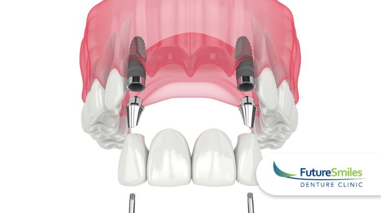 The Lifespan of Dental Implants: What to Expect