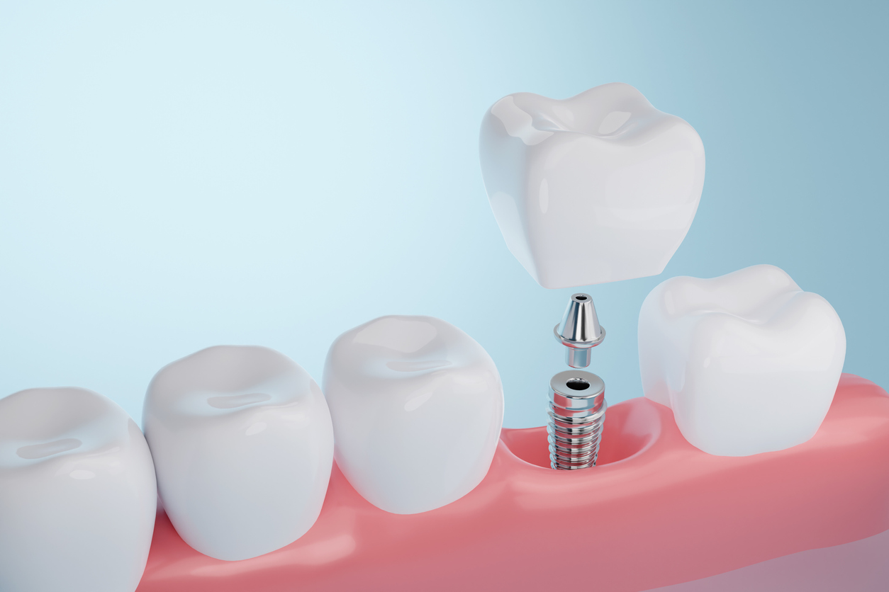 Are Dental Implants Right for You? An Overview