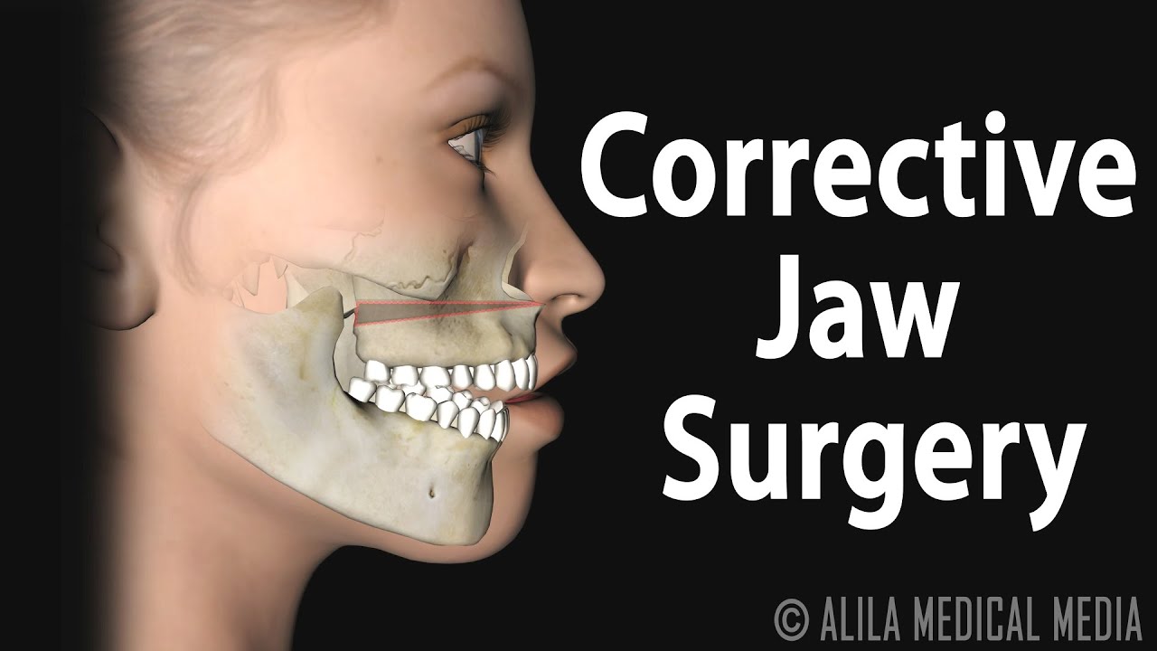 Understanding the Process of Jaw Surgery